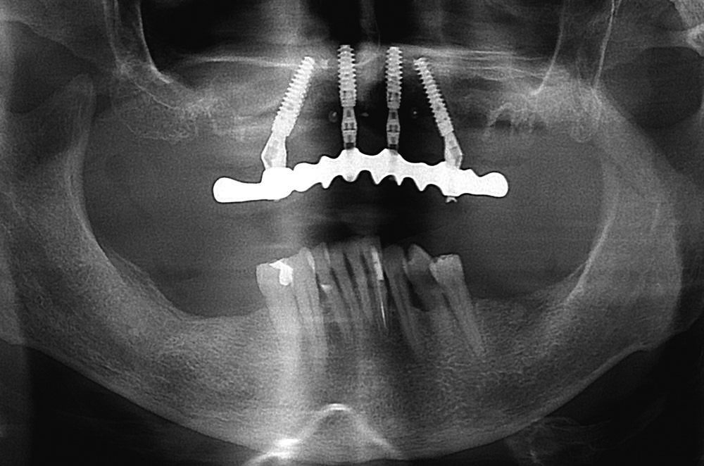 Prothèse complète sur implants dentaires Strasbourg 6